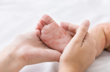 Mother holding tiny baby foot with measles rash